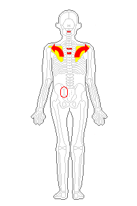 肩甲骨の翼状化