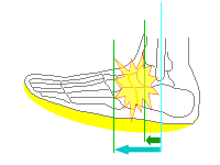 足先を挙げた状態で痛めます