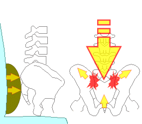 腰枕で仙骨、腸骨が押される