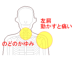 のどのかゆみ・左肩痛