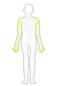 ムチ打ちで手のしびれ