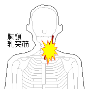 胸鎖乳突筋の痛み