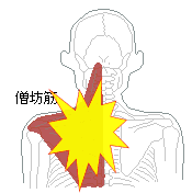 僧帽筋の痛み