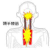 頭半棘筋の炎症で首が回わせない