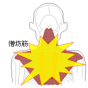 僧帽筋の炎症