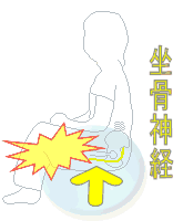 坐骨神経や血管を圧迫してしまう