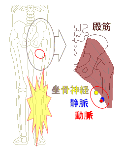 でん部の坐骨神経