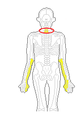 頸椎から腕のしびれ