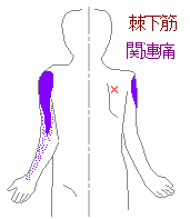 棘下筋と関連痛