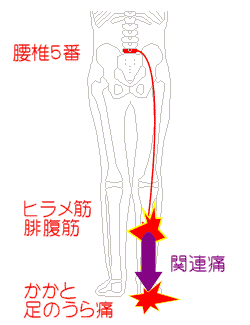 腰椎5番から足の裏痛