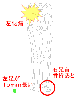 左足が15mm長い