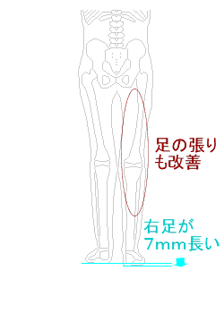 足の長さが反転、右足の張りも改善