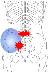 左臀部の落ち込み