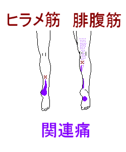ふくらはぎの関連痛で足底痛