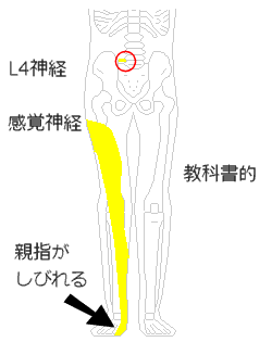 教科書的な右足のしびれ