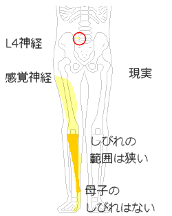 実際の右足のしびれ