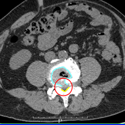 腰の骨ヘルニアのCT画像
