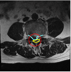 腰の骨ヘルニアのMRI画像