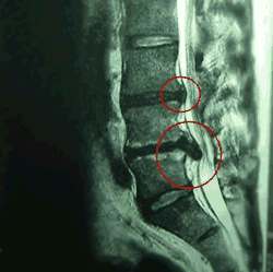 腰の骨ヘルニアのMRI側面画像