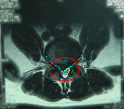 腰の骨ヘルニアのMRI断面画像