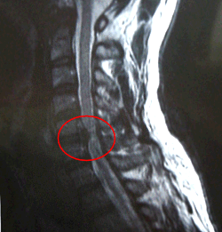 首の骨ヘルニア