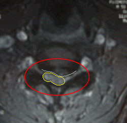 ヘルニアの水平断面