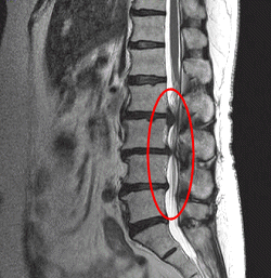 腰の骨ヘルニアのMRI画像