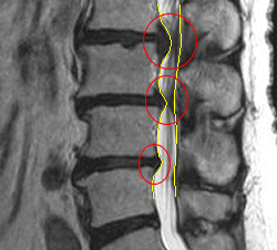 腰の骨のMRI画像を拡大