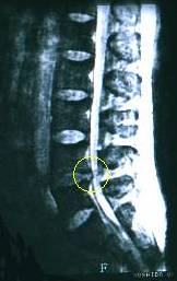 腰の骨ヘルニア