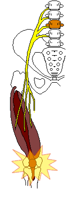 腰から膝の不調へ進行