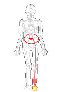 腰の骨5番から坐骨神経、かかと痛