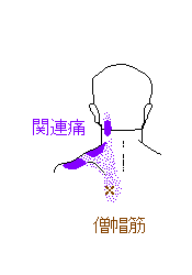 僧坊筋から肩の張り、後頭部の張り