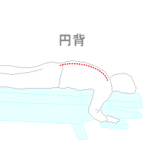 円背　腰部の後弯