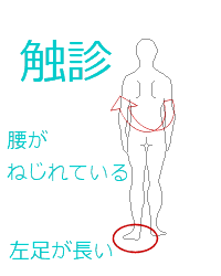 触診で腰がねじれている、左足が長い