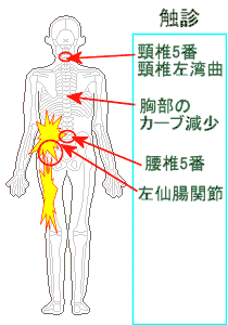 円背と左腰痛