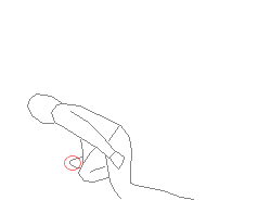 マレット骨折は、突き指から発生