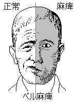 顔面麻痺（ベル麻痺）