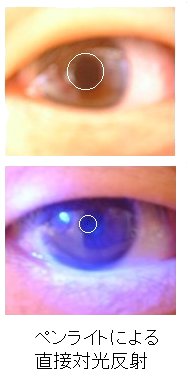 直接対光反射
