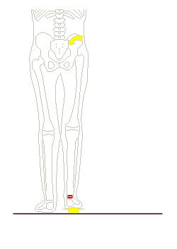 左足が短く、骨盤が後方変位