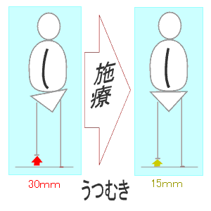 施療前後（うつむき）