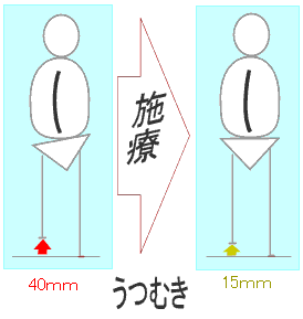 施療により足長差が減少