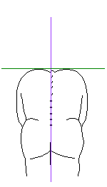 機能性　脊柱そくわん症
