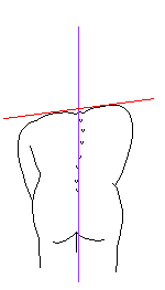構造性　脊柱そくわん症