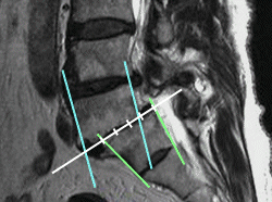 腰の骨すべり症　25%