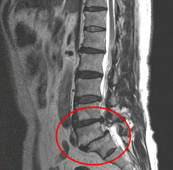 腰の骨すべり症のMRI