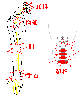首の骨と痛む部位