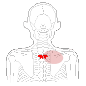背中の骨3番のズレと筋肉の硬化